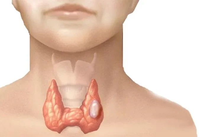 U Tuyến Giáp Ăn Gì, Kiêng Gì? Chế Độ Dinh Dưỡng Khoa Học