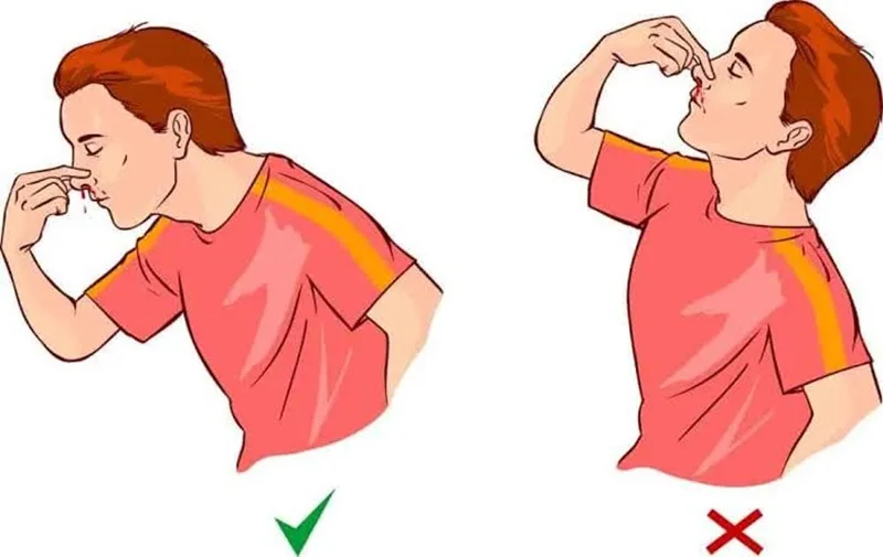Bóp chặt hai cánh mũi liên tục từ 10–15 phút là bước quan trọng nhất để giúp hình thành cục máu đông.