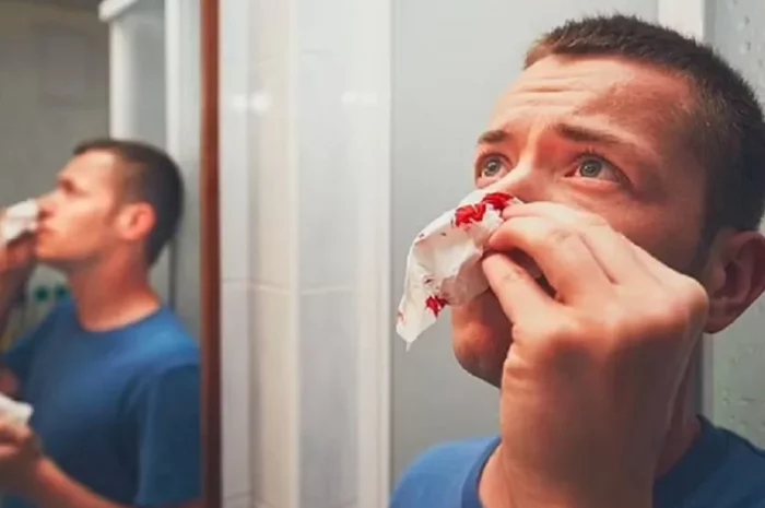 Chảy máu cam nên làm gì? Cách xử lý đúng và an toàn